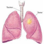 Lung Cancer Gaming