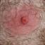Extreme Uncurable Nipple Tumor